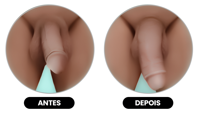 AUMENTO-PENIANO-ANTES-E-DEPOIS.1