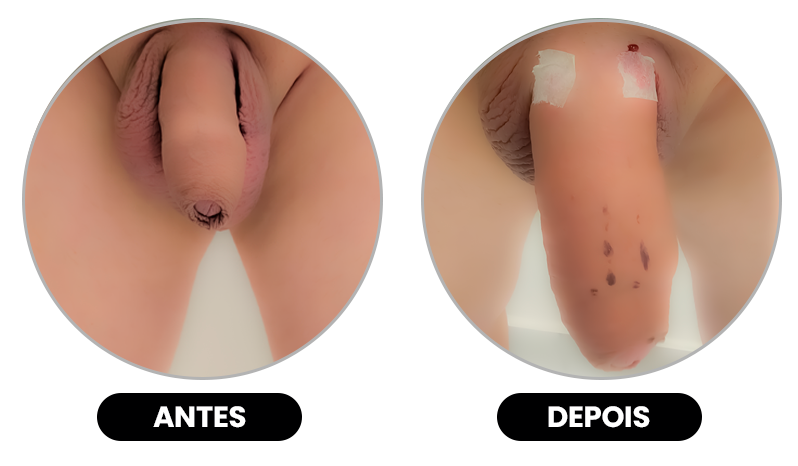 AUMENTO-PENIANO-ANTES-E-DEPOIS.4